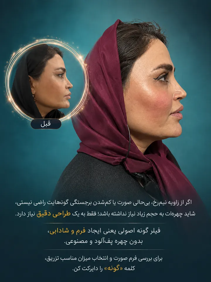 بررسی فیلر لب و زاویه نیم رخ در تهران