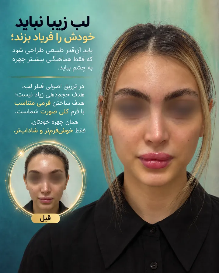 قبل و بعد فیلر لب در تهران با فرم متناسب