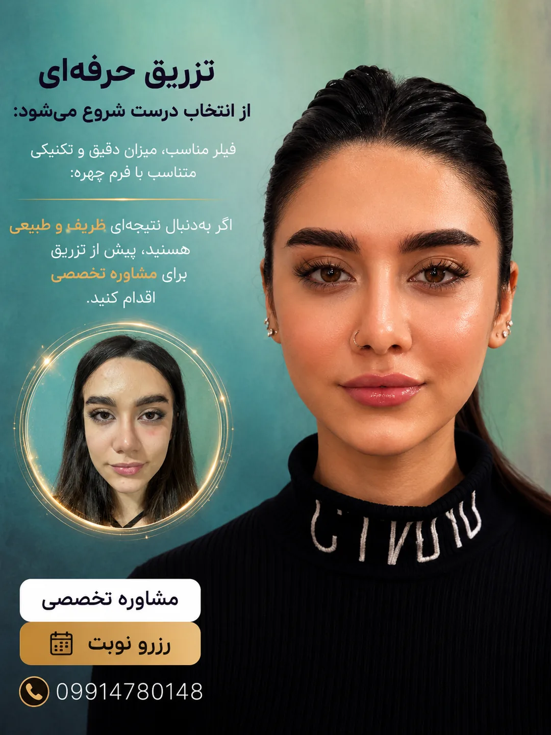تزریق فیلر لب در تهران با فرم طبیعی و متناسب با چهره