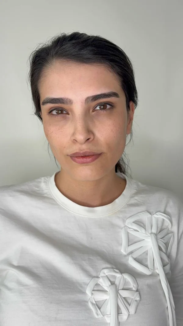 بعد از بوتاکس، تصویر ارسالی کلینیک