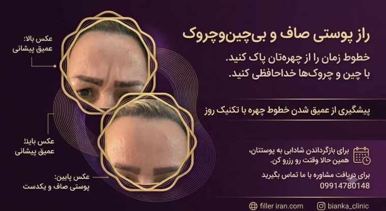 تصویر معرفی تزریق بوتاکس از آرشیو سایت